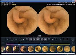Image result for Virtual Endoscopy