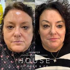 🌹🌹8 Point Facial Rejuvenation By Jennifer 🌹🌹 Lisa has had a tremendous  weight loss since we originally started treating her in clinic 5 years ago!  Lisa has had a series of tweakments