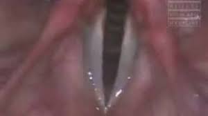 Image result for Functional Aphonia