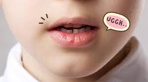 5 Cara Mengatasi Bibir Kering Pada Anak