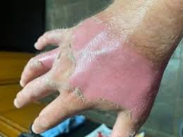 Image result for Photodermatitis