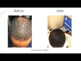 Depending on your genetic tolerance to this hormone, its cosmetic effects can range from minimal hair loss over the course of your life to noticeable hair loss, thinning and balding. Drformulas Hairomega 3 In 1 Dht Blocker Is A Hair Growth Supplement Containing Saw Palme Vitamins For Hair Growth Hair Growth Supplement Vitamins For Hair Loss