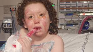 Fundraiser by Hannah Jacobs : 8yo female burn victim austic adhd
