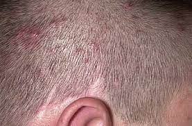 Do Fungal Infections Cause Hair Loss Hairguard Pimples On Scalp Scalp Acne Sores On Scalp