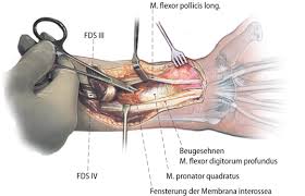 It is in the anterior compartment of the forearm. Figure 6 Transposition Der Oberflachlichen Beugesehnen Von Mittel Und Ringfinger Zur Wiederherstellung Der Daumen Und Fingerstreckung Boyes Transfer Springerlink