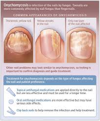 Image result for onychomycosis