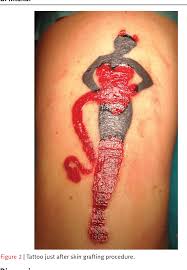 The ink will easily come off. Pdf Successful Removal Of Hyperkeratotic Lichenoid Reaction To Red Ink Tattoo With Preservation Of The Whole Tattoo Using A Skin Grafting Knife Semantic Scholar