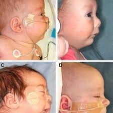 PDF) MicroNAPS: A Novel Classification for Infants with Micrognathia, Robin  Sequence, and Tongue-based Airway Obstruction