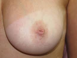 Inverted nipple treatment 40 yr old Scottsdale Phoenix Mesa