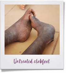 Image result for Clubfoot