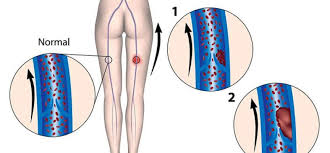Hay muchas cosas que pueden causarle dolor e inflamación en la pierna, pero si los síntomas son el resultado de un coágulo sanguíneo en una vena profunda de la pierna, esto puede ser peligroso. Trombosis Venosa Profunda Cronic Es Portal De La Asociacion Espanola De Enfermos Y Enfermas Con Enfermedades Cronicas