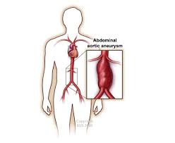 They usually cause no symptoms except when ruptured. Abdominal Aortic Aneurysm Society For Vascular Surgery