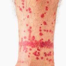 Image result for flea bites