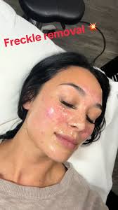 Barbara O Neil Removing Freckles