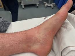 Image result for Scombroid Fish Poisoning