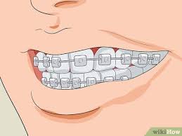 How to stop clenching teeth. How To Stop Clenching Jaw 14 Steps With Pictures Wikihow