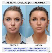 Lacey anne douthat of the glitter gospel shares her experience with under eye filler with the lucas. Gorgeous Non Surgical Before And After Result By Dr David Mabrie Www Yourfaceinourhands Com Staybeautiful Beautiful Facial Fillers Botox Juvederm
