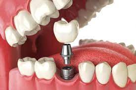 We cater for patients of all ages from young children through to the elderly. Affordable Dental Implants In Franklin Wi Top Rated Implant Dentist Near Me Dental Implants In Oak Creek Anderson Family Dental