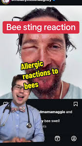 Matthew McConaughey recently had a bee sting reaction. How to treat an  allergic reaction to a bee sting? What is anaphylaxis? Any concern for a  systemic reaction to bee stings should be evaluated by ...