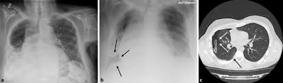 Disponerende faktorer er rygning (inkl. Therapie Des Pneumothorax Und Thoraxdrainage Management Springerlink
