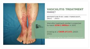 Image result for Vasculitis