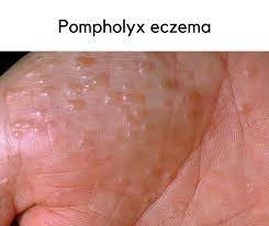 Image result for pompholyx soles of feet