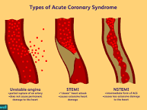 Image result for icd 10 code for acute st elevation myocardial infarction