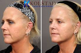 We've already talked about how the sun is one of the number one causes of wrinkles, yet we can't. Cheek Fillers Smile Line Fillers Results Dr Kolstad San Diego Facial Plastic Surgeon