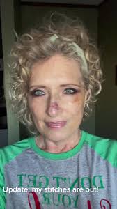 Skin Cancer Surgery Recovery Update