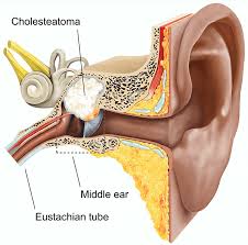 Surgery For Cholesteatoma Healthdirect