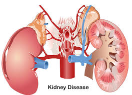 Chronic kidney disease (ckd) is a type of kidney disease in which there is gradual loss of kidney function over a period of months to years. Kidney Diseases Creative Biolabs