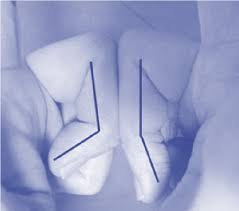 Image result for Elson Extensor Tendon Test