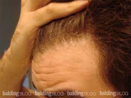 Hair generally takes around 3 to 6 months to regrow after weight loss. 24 Year Old Has Hair Loss After Losing Weight With Photos Wrassman M D Baldingblog