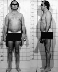 170 cm to feet and inches. Patient At Diagnosis At Age 40 Years And Diagnosis Of Hpp Our Patient Download Scientific Diagram