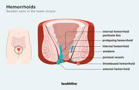 Image result for Hemorrhoid