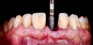 However, dental implant treatment may not be suitable for all patients. Best Implant Dentist In Nj Affordable Dental Implants In Nj Monroe Twp Highland Park Fiorentini Family Dentistry