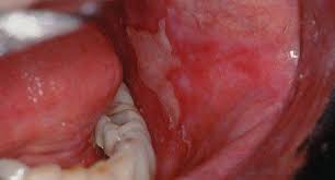 Image result for lichen planus on tongue)