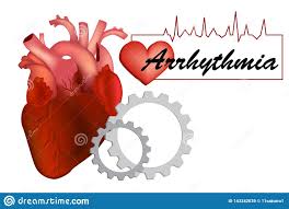 Heart Arrhythmia Or Irregular Heartbea Stock Vector