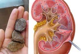 Simak penjelasan dan saran ahli agar batu ginjal tak lagi kambuh setelah dioperasi. Benarkah Urine Berdarah Tanda Awal Batu Ginjal Ini Penjelasannya Semua Halaman Grid Health