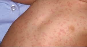 Adverse Reaction to MMR Immunization | Consultant360