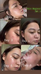 Thank you very much Skin Magical! I was amazed by the result of your  product. There was so many people na ang nakakapansin sa pagbabago ng face  ko. I really recommend Skin