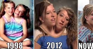 20 Interesting Things About Famous Conjoined Twins Abby And Brittany Hensel Conjoined Twins Fun Facts Twins
