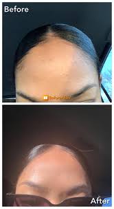 Exfoliant, toner, moisturizer, redness relief Paula S Choice Bha Exfoliant Was My Hg For Closed Comedones 2 Weeks Difference Skincareaddicts