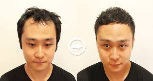 前編 男の薄毛を自然に隠せる髪型22選 o字m字などハゲを熟知した美容師のヘアカタログ aga対応髪型 8番目の画像 薄毛ヘアスタイル 美容師 ファッション 薄毛