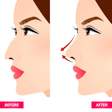 A partir de un presupuesto límite o una. Rhinoplastik Wirkt Turkish Rhinoplasty Center
