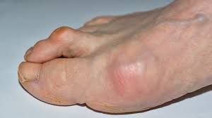 Image result for Hammer toe