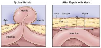 Beth Israel Hernia Center Hernia Types Hernia Surgeon Nyc Hernia Repair Umbilical Hernia Umbilical Hernia Repair