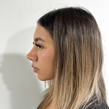 Fotografías de nuestra bella paciente a tan solo 1 mes de su rinoplastia  ultrasónica y estructural💯💯✔️✔️ En este caso nuestra paciente nos  solicitó una nariz natural, con una ligera curva y con