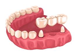 What Are The Types Of Dental Bridges You Can Get G4 By Golpa