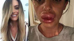 Defiguree Lors D Une Soiree Botox L Estheticienne Etait Une Ancienne Prisonniere Sans Formation